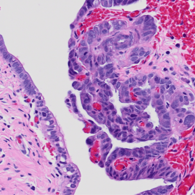 Ovarian cancer cells.