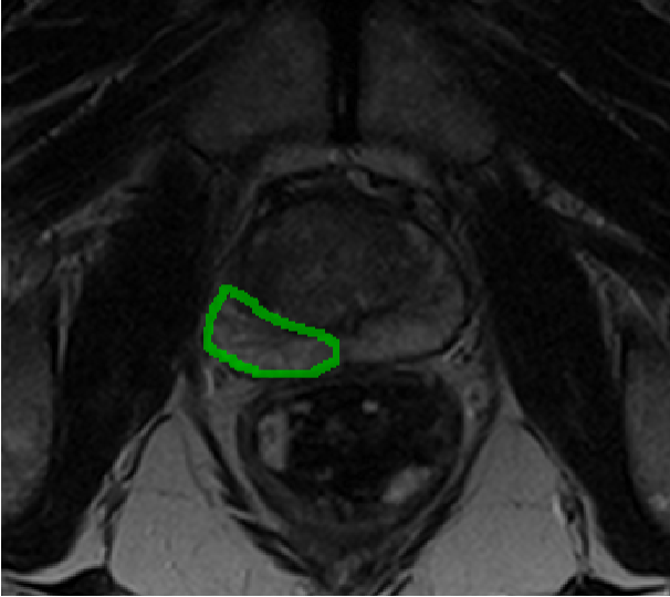 Prostate tumour scan.