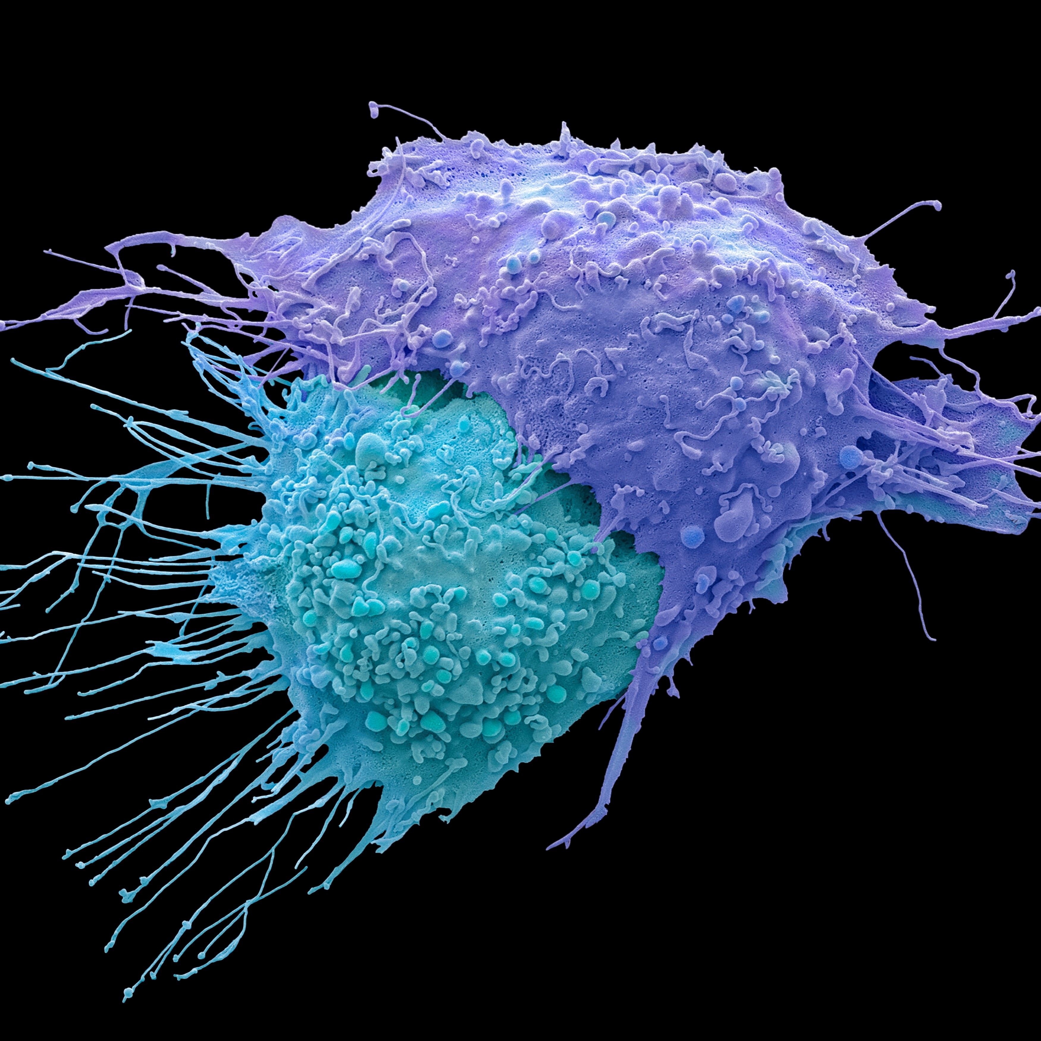 Ovarian cancer cell.