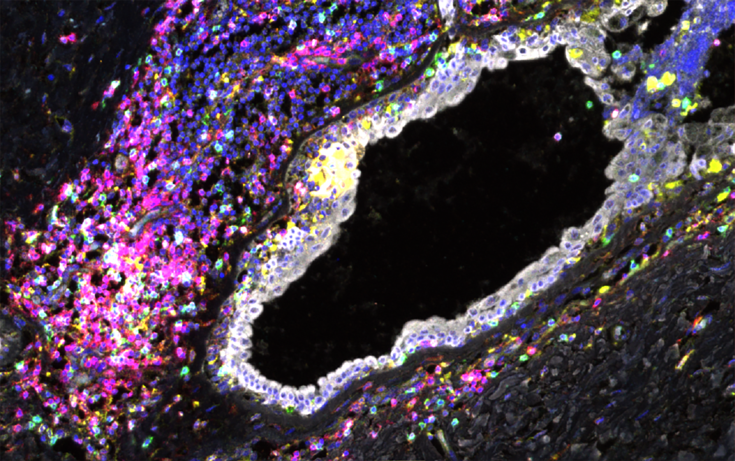 Mapping of breast cancer premalignancy.